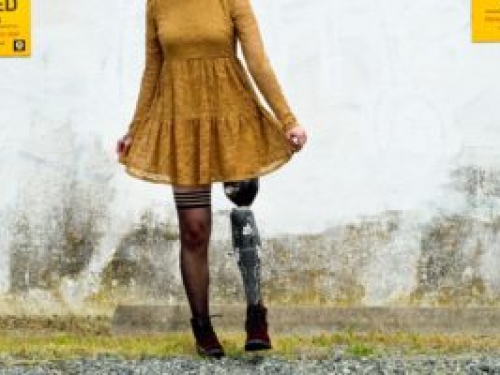 Woman with prosthetic leg wearing short dress